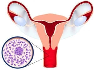 Bacterial Vaginosis