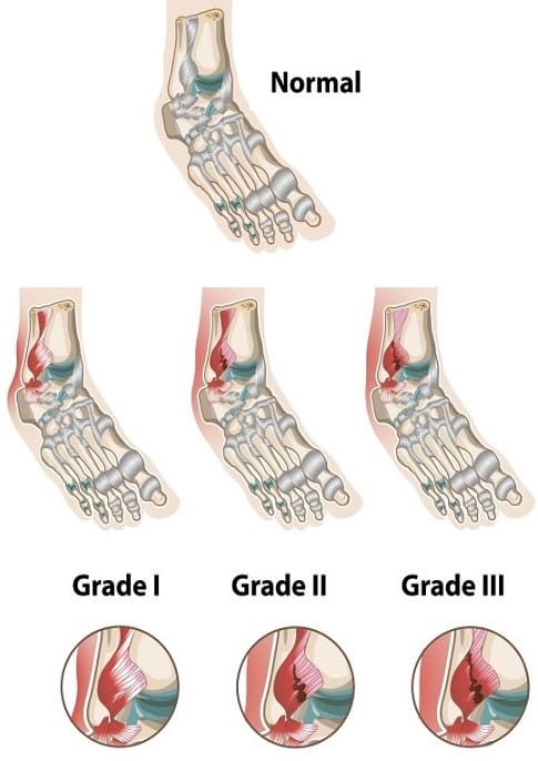 Grades of ankle sprains MedFog