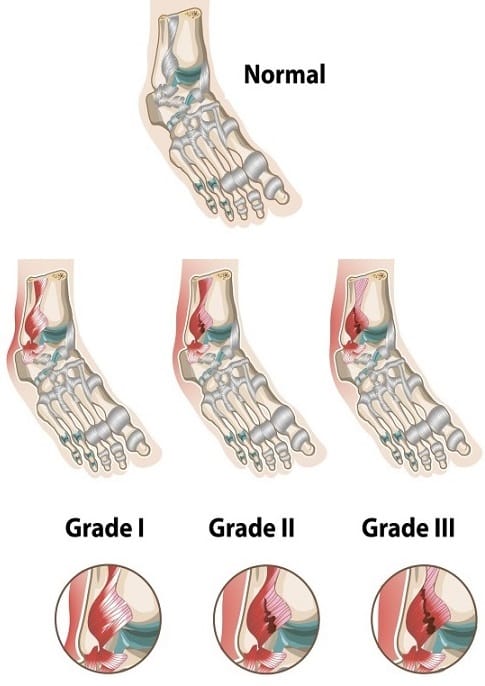 Ankle Sprain - Symptoms, Diagnosis and Treatment - MedFog