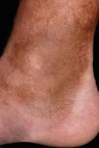 Leg - Hemosiderin staining