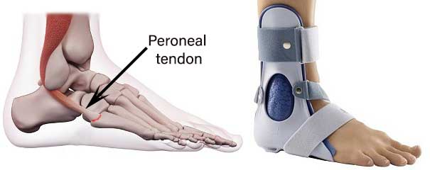 Peroneal Tendon Injury medfog