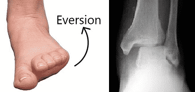 lateral shift of the talus on everting the ankle MedFog