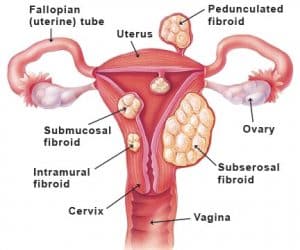 fibroids