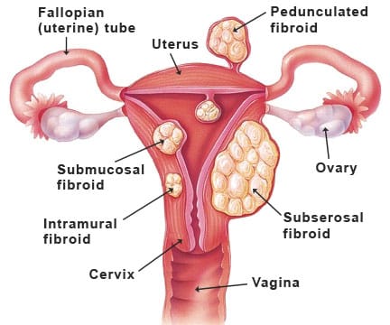 fibroid