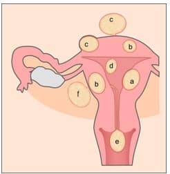 fibroid based on the place