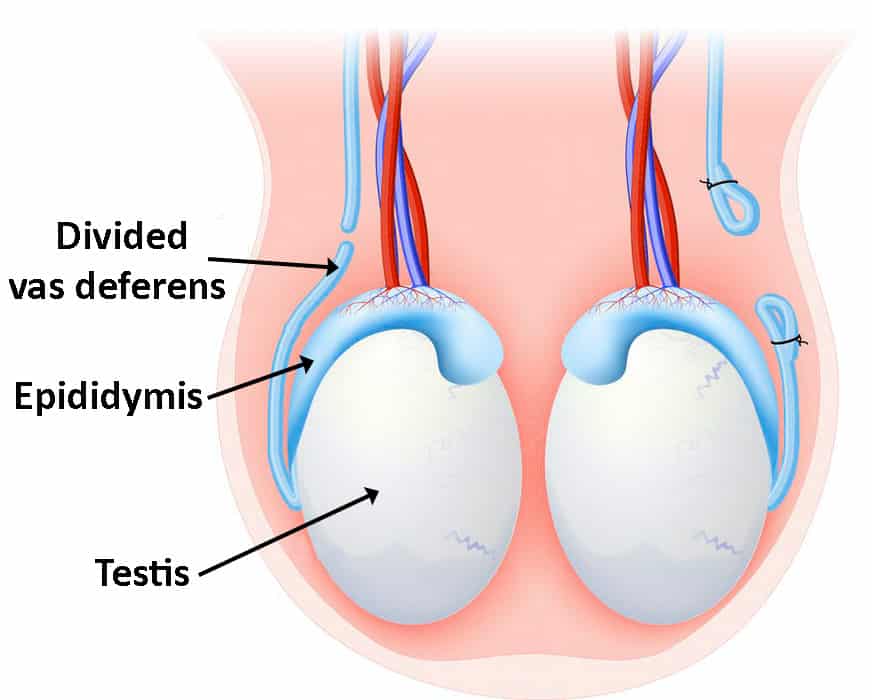 Vasectomy ligation