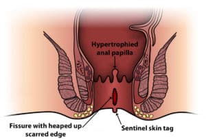 Chronic anal fissure