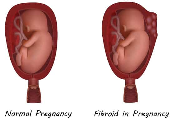 Normal pregnancy and Fibroid in pregnancy