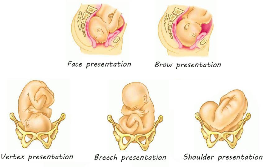 malpresentation-of-the-fetus