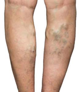 Varicose veins