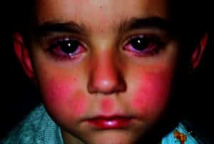 Kawasaki Disease