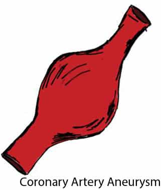 coronary artery aneurysm